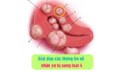 Giải đáp các thông tin về nhân xơ tử cung loại 4