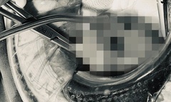 Cụ bà thủng tử cung, ổ bụng có dịch mủ sau một tuần táo bón