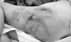 Cụ ông hoại tử vùng mông, đùi vì 1-2 nốt mụn nhọt