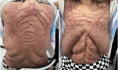 Người phụ nữ da nổi vết rạn như da rắn vì bôi thuốc trị ngứa mua trên mạng