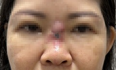 Bi hài hậu vận thẩm mỹ: Bị chê  "mũi thấp, vận nghèo ", người phụ nữ chi 65 triệu  "đổi vận " và cái kết hoại tử mũi