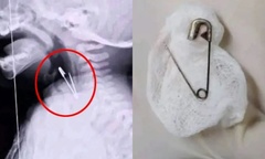 Chụp X-quang họng bé 7 tháng tuổi, bác sĩ phát hiện  "vật thể lạ " bên trong