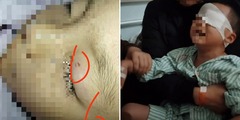 Giáo viên bôi mỡ lợn vào vết thương ở mắt khiến bé trai 4 tuổi bị mù vĩnh viễn tại Trung Quốc