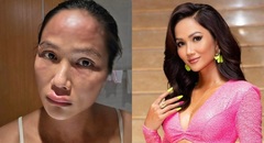  "Bệnh lạ " mà Hoa hậu H'Hen Niê mắc phải sau sinh nguy hiểm ra sao?