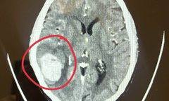 Người phụ nữ thoát đột quỵ nhờ sáng suốt “đi viện ngay khi thấy mặt méo”