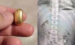 Con trai 11 tuổi nuốt hạt đậu vàng trị giá 37 triệu đồng, mẹ  "đứng ngồi không yên " suốt 5 ngày