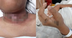Bé trai 9 tuổi bỏng nặng do thói quen sạc máy tính bảng gần giường