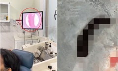 Tin tức đời sống 19/11: Con đỉa 6cm sống trong mũi cụ bà suốt 3 tuần