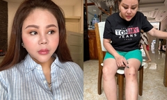 Lê Giang ngừng đóng phim vì có dấu hiệu teo cơ chân do thoát vị đĩa đệm