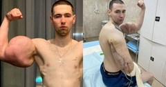  "Quái vật phòng gym " nguy cơ mất cả hai cánh tay vì nhiễm trùng nghiêm trọng