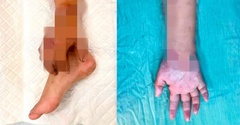 Tin tức đời sống 1/12: Bàn tay bị đứt của mẹ bầu được nối lại sau thời gian  "nuôi " ở chân