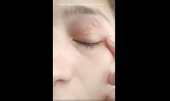 Người phụ nữ mắt khó chịu, bác sĩ gắp ra thứ  "đáng sợ " khiến ai cũng rùng mình