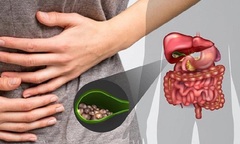 Tại sao sỏi mật lại thường gặp ở phụ nữ?