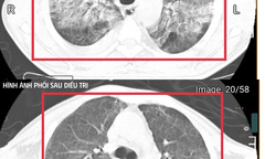 Suy đa tạng khi mang vi khuẩn  "tử thần " từ nước ngoài trở về