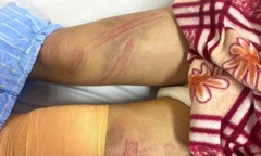 Vụ nữ sinh ở Nghệ An nhập viện với nhiều vết bầm tím: Lãnh đạo phường nói gì?