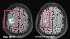 Người đàn ông co giật cứ ngỡ do u não, đi khám mới biết có sán làm tổ
