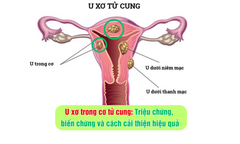 U xơ trong cơ tử cung: Triệu chứng, biến chứng và cách cải thiện hiệu quả