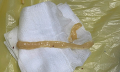  "Ký sinh " dài gần 1 mét ngọ nguậy trong đại tràng người đàn ông bỗng dưng sụt cân bất thường