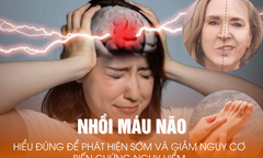 Nhồi máu não: Hiểu đúng để phát hiện sớm và giảm nguy cơ biến chứng nguy hiểm