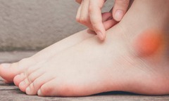 6 dấu hiệu bất thường ở chân cảnh báo thận của bạn đang "kêu cứu "