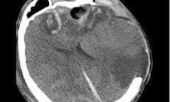 Cứu sống ngoạn mục mẹ con du khách người Nga bị chấn thương sọ não nguy kịch