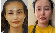 Bắt  "nữ quái " phẫu thuật thẩm mỹ để trốn lệnh truy nã