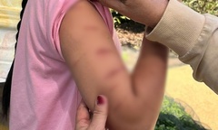 Sở Y tế tỉnh thông tin vụ nữ sinh lớp 5 ở Cà Mau bị chị họ gây thương tích