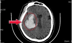 Tin tức đời sống 10/2: Người đàn ông đột ngột ngã gục sau khi tăng huyết áp không triệu chứng
