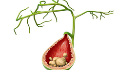 [Giải đáp] Vì sao sỏi mật hay tái phát và cách phòng ngừa hiệu quả