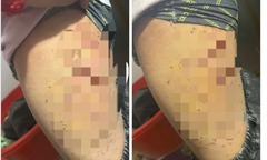 Vụ nữ sinh lớp 7 bị bạn dùng bút đâm vào đùi ở Lào Cai: Hé lộ nguyên nhân