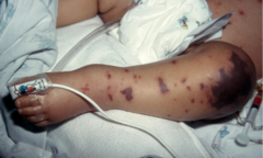 Từ vụ bé gái 11 tuổi tử vong nghi não mô cầu: Chuyên gia chỉ ra sai lầm từ sự chủ quan ban đầu