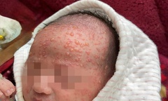 Trẻ sơ sinh 12 ngày tuổi nguy kịch vì thủy đậu, bác sĩ cảnh báo biến chứng không thể chủ quan