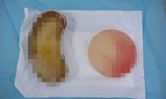 Phát hiện vỡ túi ngực sau 5 năm: Biến chứng âm thầm và cảnh báo của bác sĩ