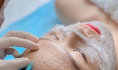 Người phụ nữ bị nhiễm trùng nặng, sưng phù toàn mặt sau tiêm meso tại nhà