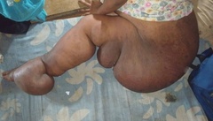 Căn bệnh lạ khiến đôi chân của người phụ nữ sưng phồng như chân voi