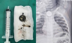 Bé 24 tháng tuổi bị bỏng sâu thực quản do nuốt pin cúc áo