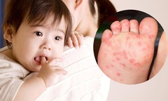 Bệnh tay chân miệng diễn biến phức tạp, cha mẹ chủ động phòng ngừa cho trẻ như thế nào?