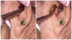 Đi khám vì ngỡ ù tai, người phụ nữ bàng hoàng khi bác sĩ gắp ra  "vật thể lạ " 