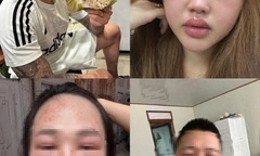 Bắt trend ăn bánh trứng kiến, nhiều người mặt sưng phù: Bác sĩ cảnh báo khẩn