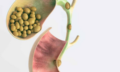 Sỏi mật: Ít dấu hiệu cảnh báo nhưng tiềm ẩn nhiều biến chứng nguy hiểm