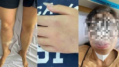 8 người nhập viện cấp cứu do ong rừng tấn công khi đi tảo mộ