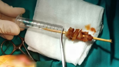 Bé gái 2,5 tuổi gặp nạn khi ăn thịt xiên nướng