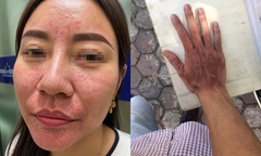 Gia tăng bệnh lý về da mùa nắng nóng: Bảo vệ thế nào cho đúng cách?