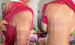 Bà hoảng hồn phát hiện trên người cháu đầy vết bầm tím, vội trình báo công an