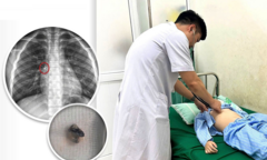 Được mẹ nhổ răng tại nhà, bé trai phải nhập viện sau sự cố hy hữu