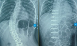 Ca phẫu thuật lần đầu tiên có ở Việt Nam