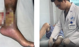 Tự điều trị vết loét chân kéo dài, người phụ nữ đối mặt nguy cơ biến chứng