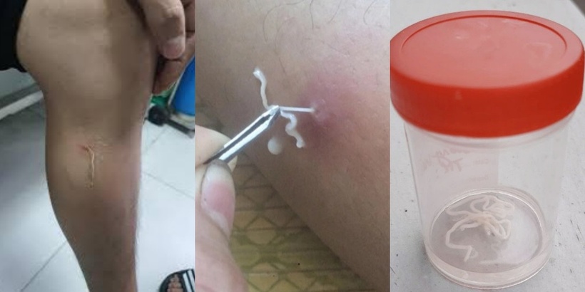 Mẫu bệnh phẩm được lấy trên người bệnh nhân