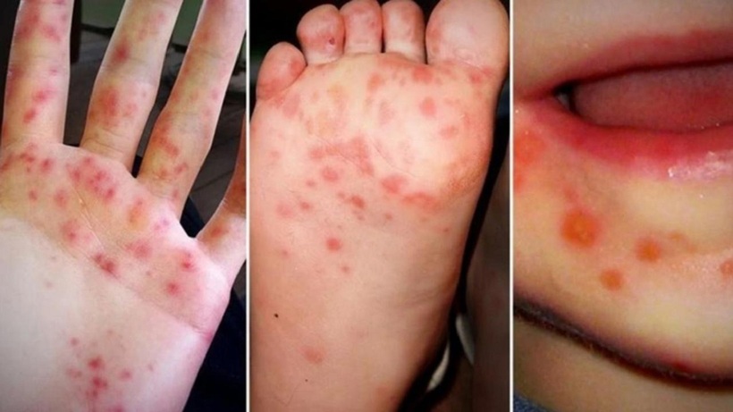 Hà Nội phát hiện nhiều ổ dịch tay chân miệng mới trong tuần qua. Ảnh minh họa.