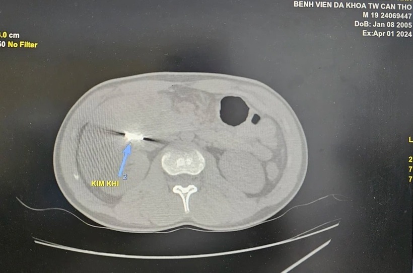 Mắt xích máy cưa nằm trong ổ bụng bệnh nhân. Ảnh: Pháp luật TP.HCM